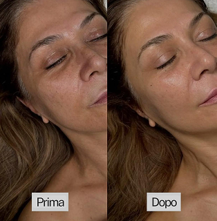 Immagine prima-dopo trattamento viso